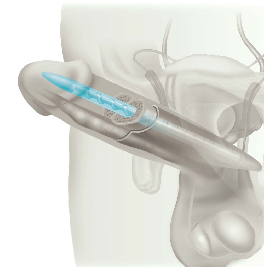 Illustration of Genesis® Penile Implant