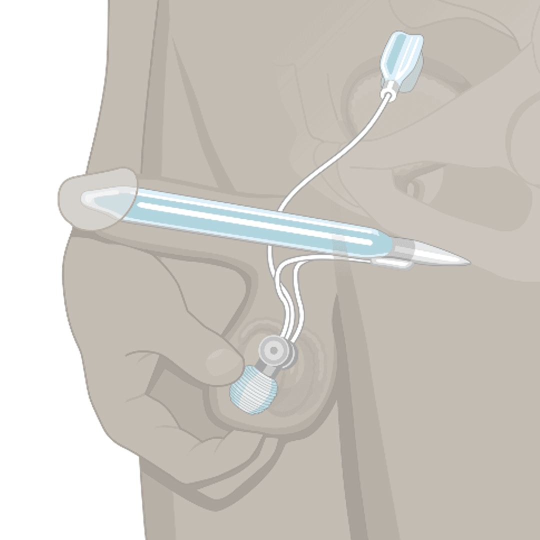 Illustration of a penile implant inside a man's body